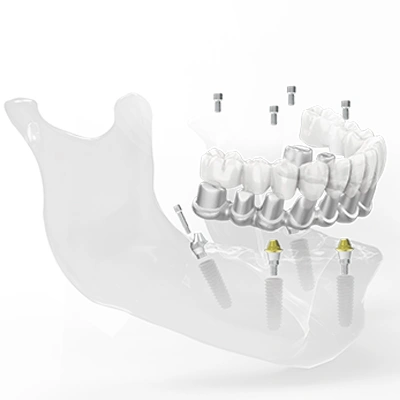 Puente dental