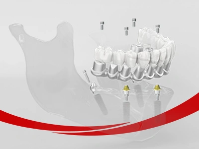 Puente dental