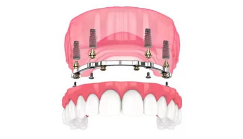 Prótesis sobre implantes